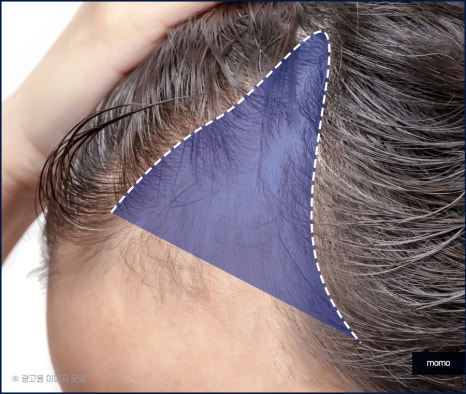 헤어라인 교정 비용 및 방법 디자인의 중요성 관련 이미지 6
