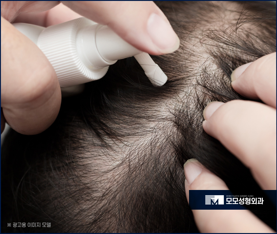 미녹시딜여자 효과와 치료 방안에 대해 관련 이미지 5