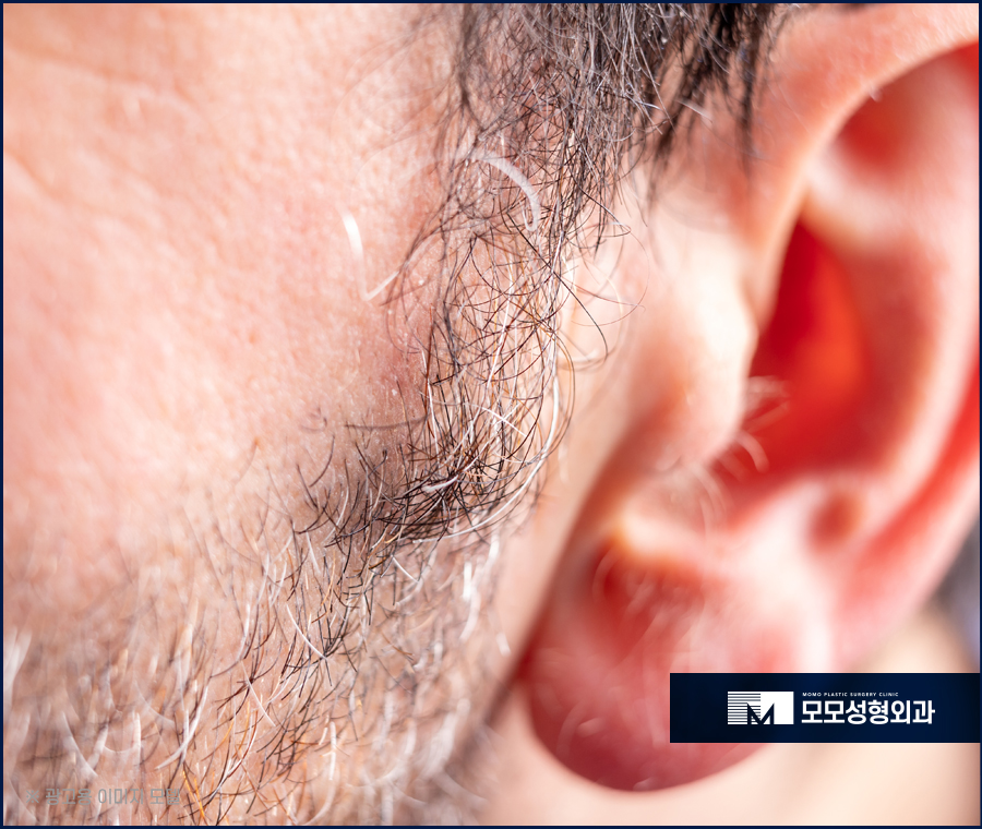 남자 옆머리 탈모 구레나룻의 양이 부족하다고 느껴질 경우엔 관련 이미지 7