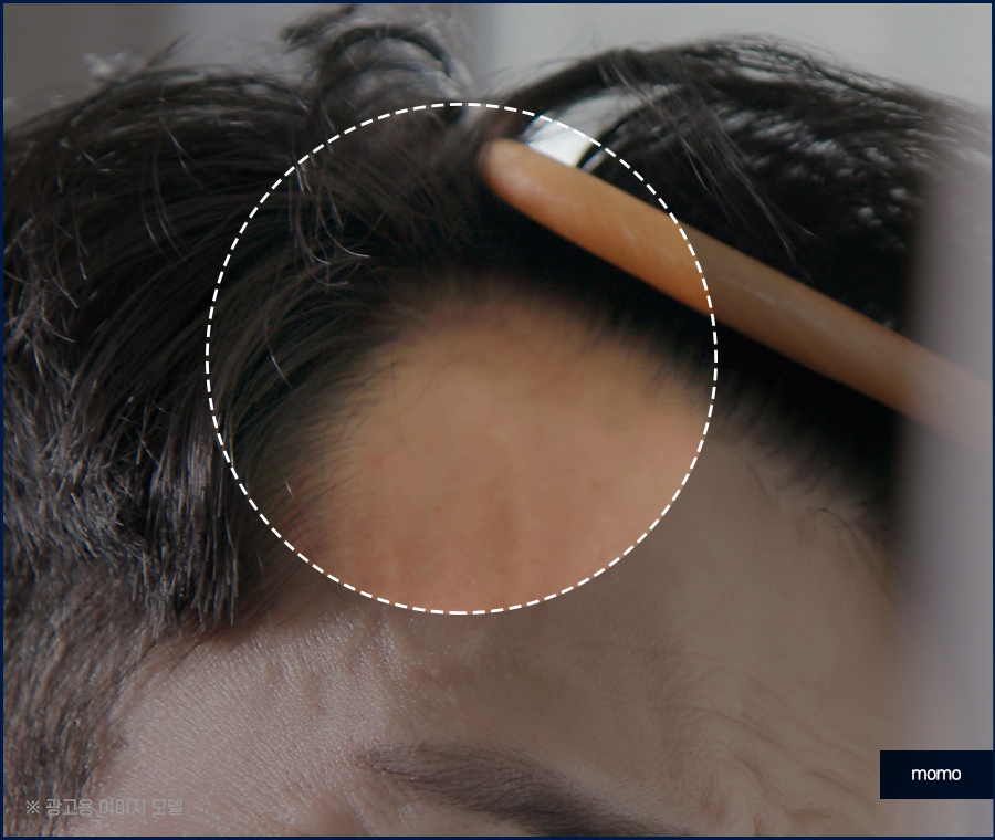 m자탈모초기 현상과 빠르게 대처하면 좋은 포인트는 관련 이미지 6
