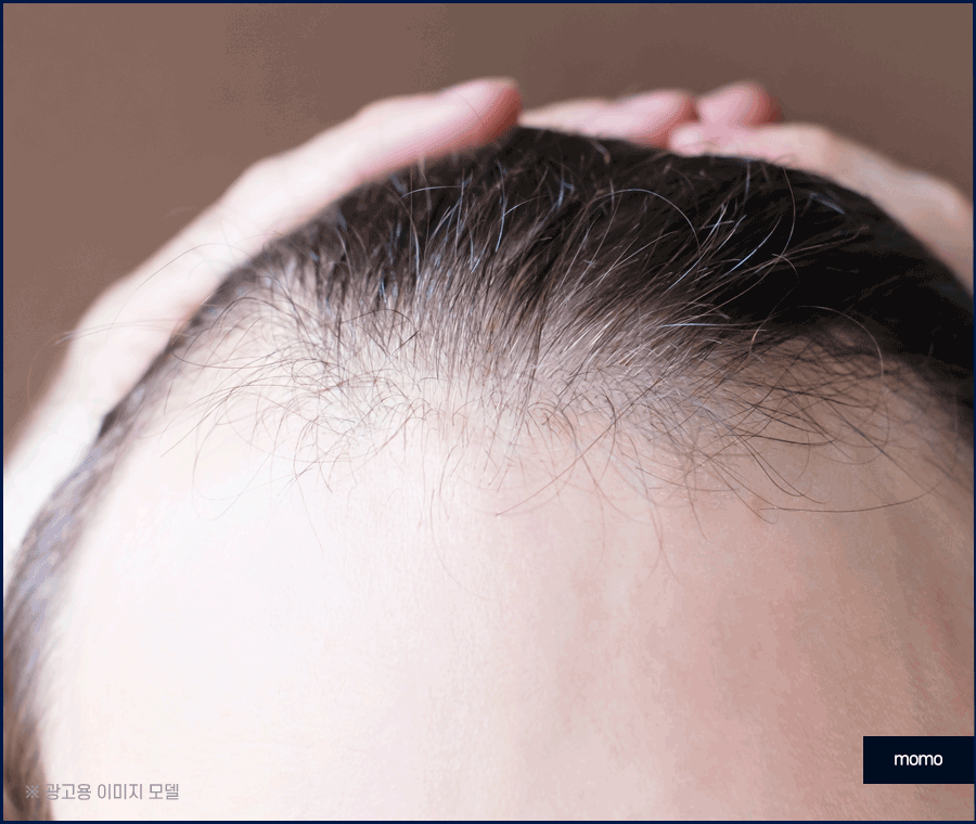 강남 탈모 병원 원인 파악부터 철저하게 시작하는 곳 관련 이미지 7