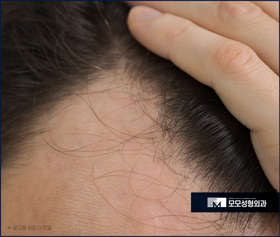 M자탈모병원 깊이 파인 헤어라인이 고민일 경우 관련 이미지 3