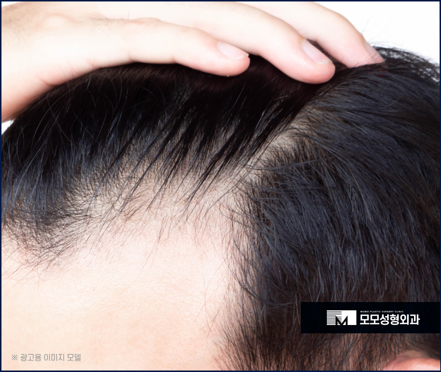 여자엠자탈모 인상까지 변화될 수 있도록 관련 이미지 4