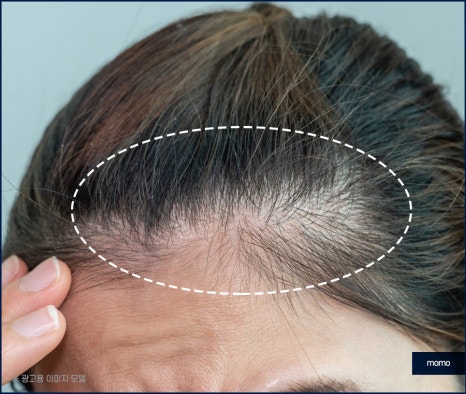 헤어라인 교정 비용 및 방법 디자인의 중요성 관련 이미지 9