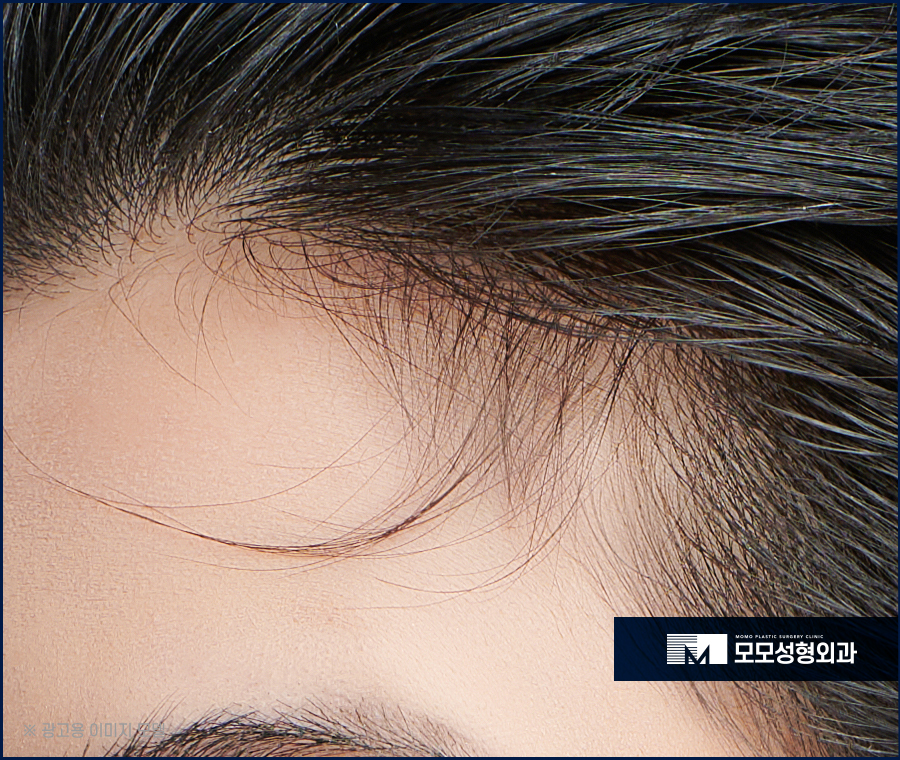 여성헤어라인모발이식 보강이 필요하다면 관련 이미지 3