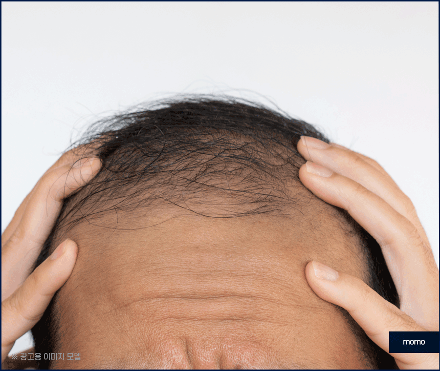 탈모약 처방 및 주의사항, 회복을 위한 대안 관련 이미지 5