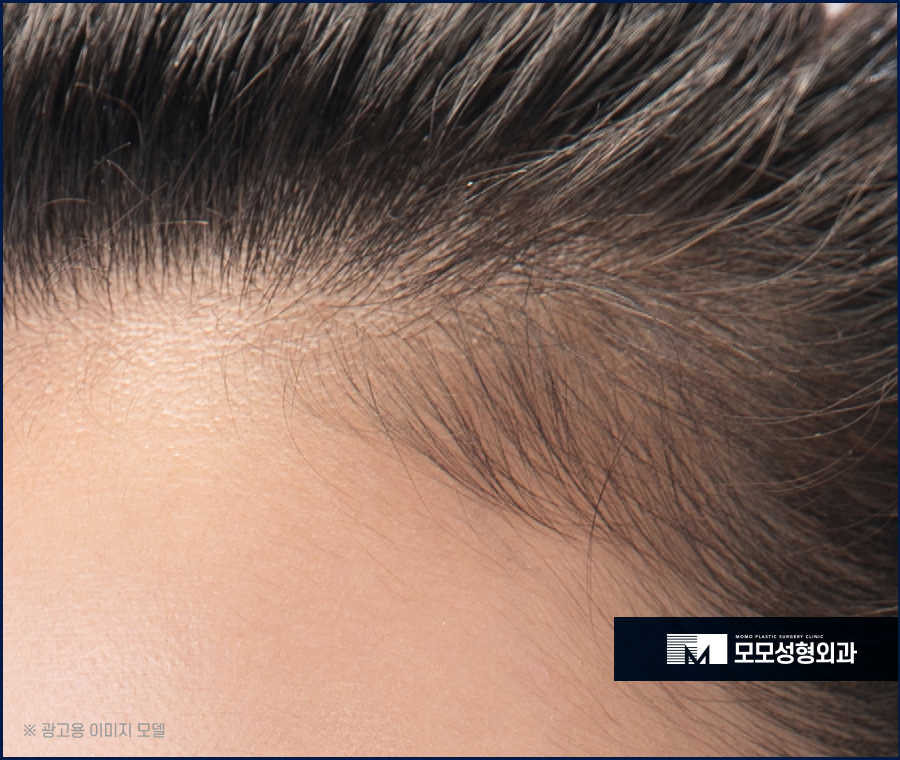 여자M자이마탈모 개인맞춤 진행의 중요성에 대하여 관련 이미지 5