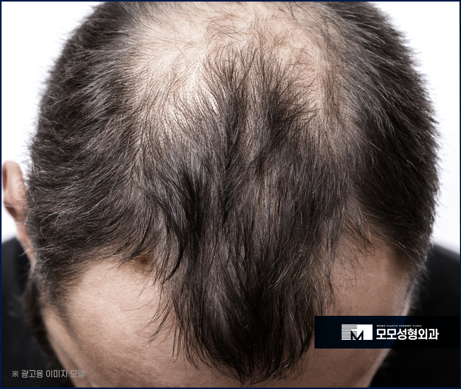 서울모발이식 고려하고 있다면 꼭 확인할 점은 관련 이미지 3
