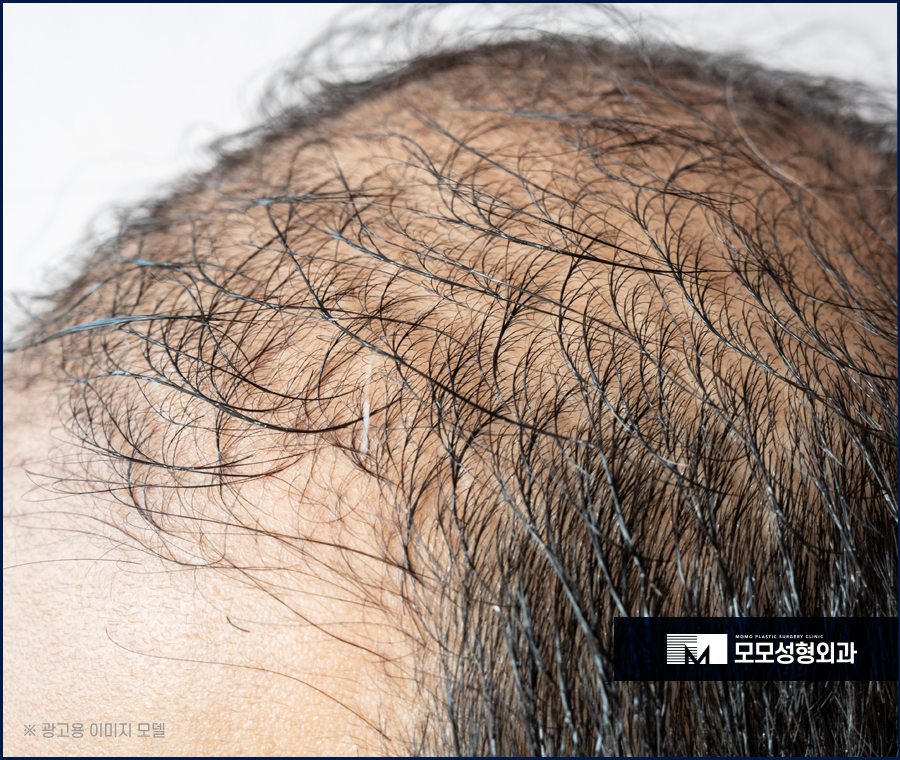 남자연예인모발이식 준수한 외모를 위한 선택 관련 이미지 3