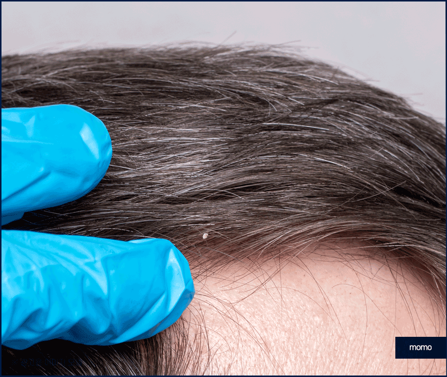 엠자 탈모 섬세하게 채워 만드는 변화 관련 이미지 8