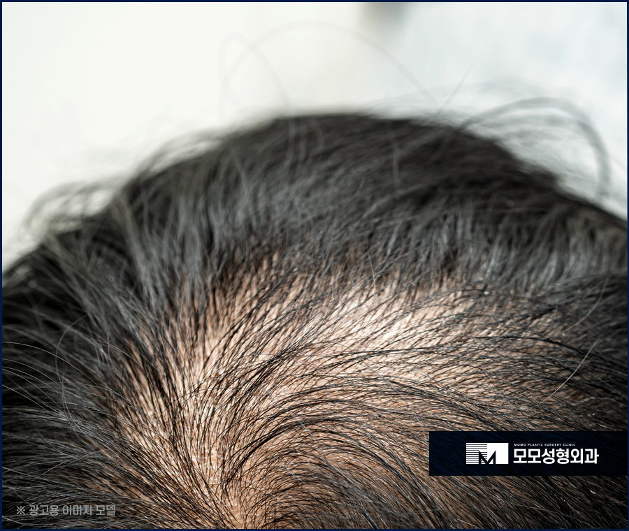 미녹시딜 5% 효과와 사용 전 알아두어야 할 점 관련 이미지 5