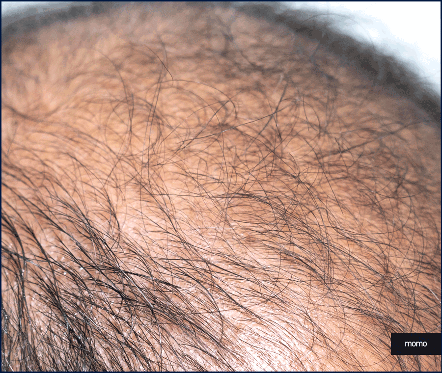비절개모발이식가격 확인보다 중요한 점 관련 이미지 11