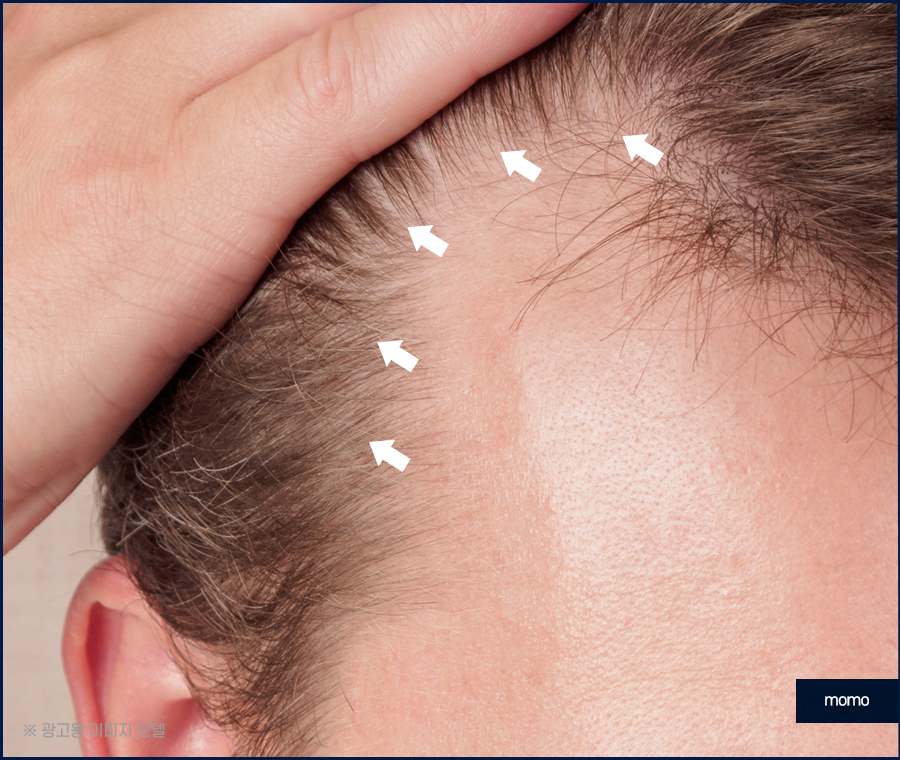 모발이식잘하는곳 찾는 결정적인 기준 관련 이미지 9