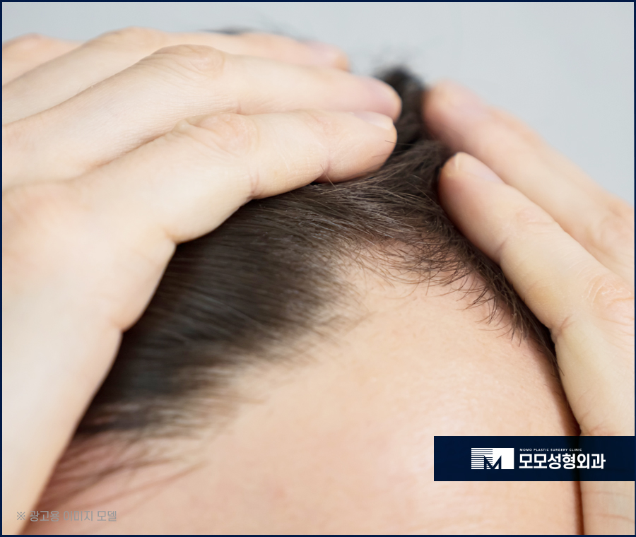 여자이마탈모 유발하는 원인과 개선 방법까지 관련 이미지 4