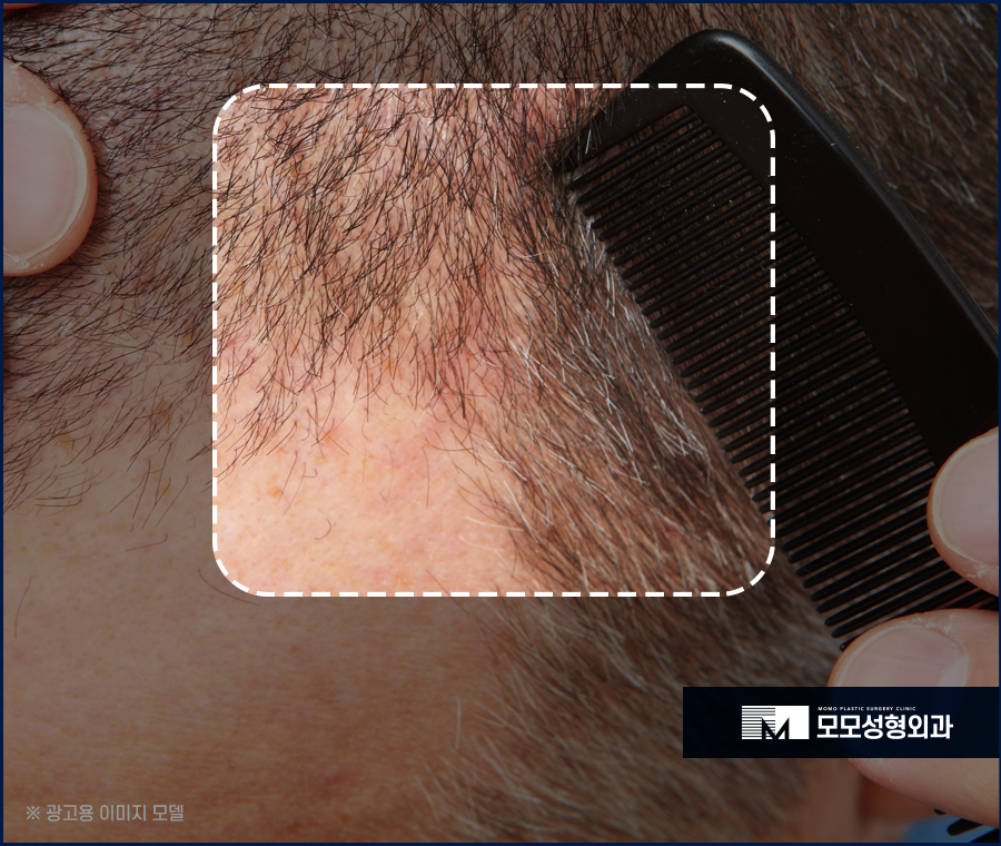 우습게 여기지 말아야 할 헤어라인 뾰루지 관련 이미지 7