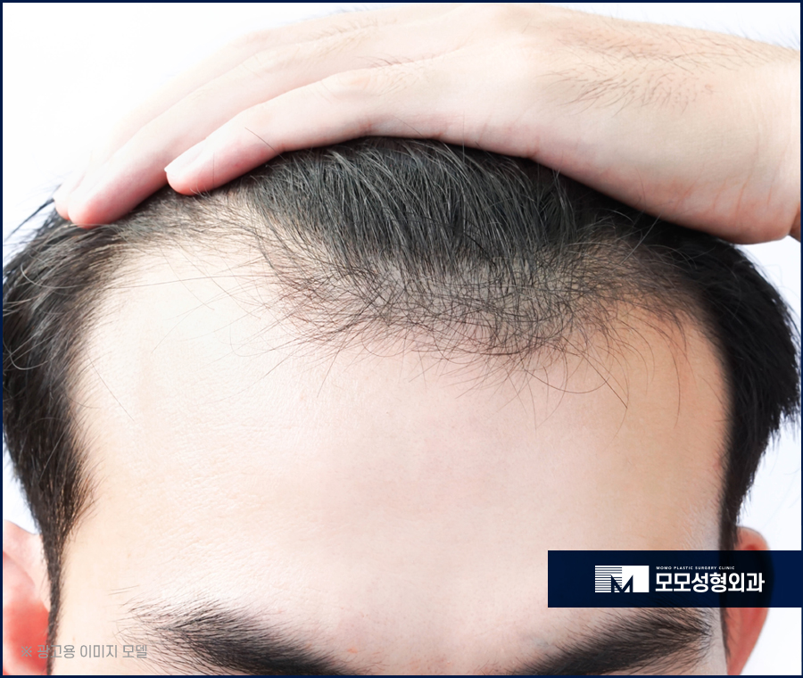 압구정탈모치료 처치 방안을 알아볼 땐 관련 이미지 3
