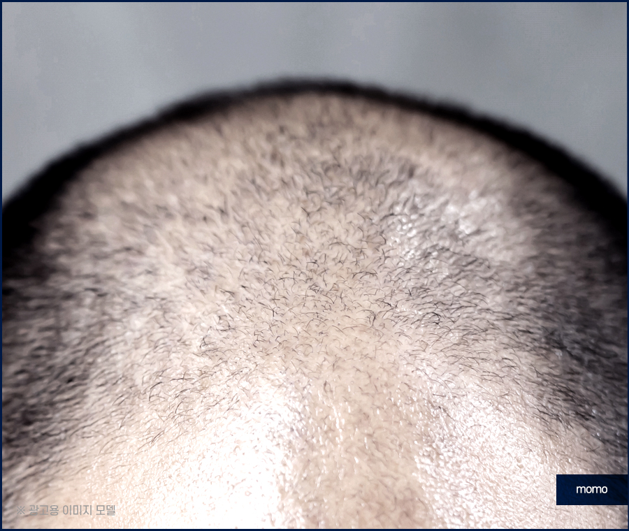 남자 헤어라인 교정 불규칙한 라인 보완을 위해 관련 이미지 12