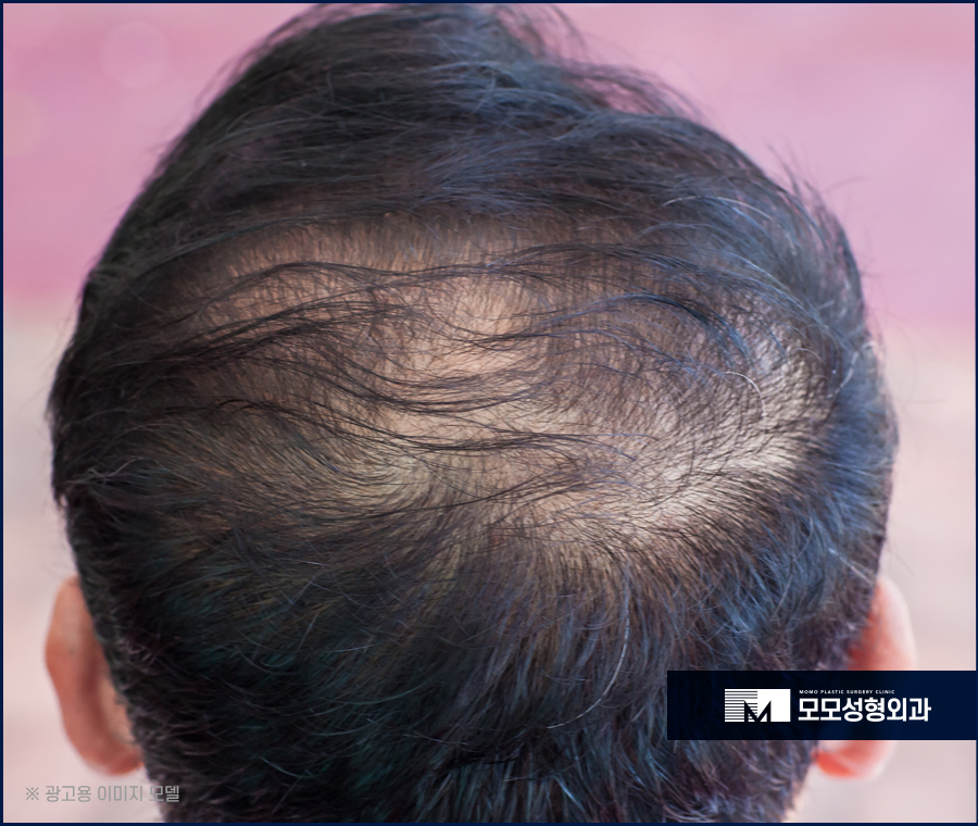 서울모발이식병원 전체적으로 자연스러운 관련 이미지 4