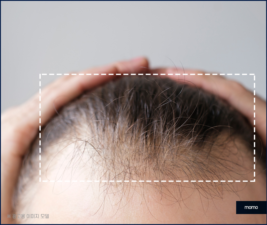 머리카락 끊어짐 이유부터 호전을 위한 Tip 관련 이미지 4