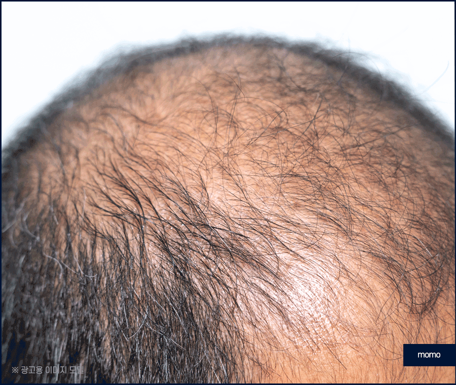 전두탈모 원인 보강을 위한 현명한 선택은? 관련 이미지 8