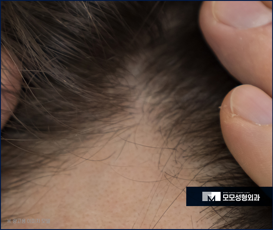 20대 여자 가르마 탈모 빠른 대응이 중요한 이유 관련 이미지 3