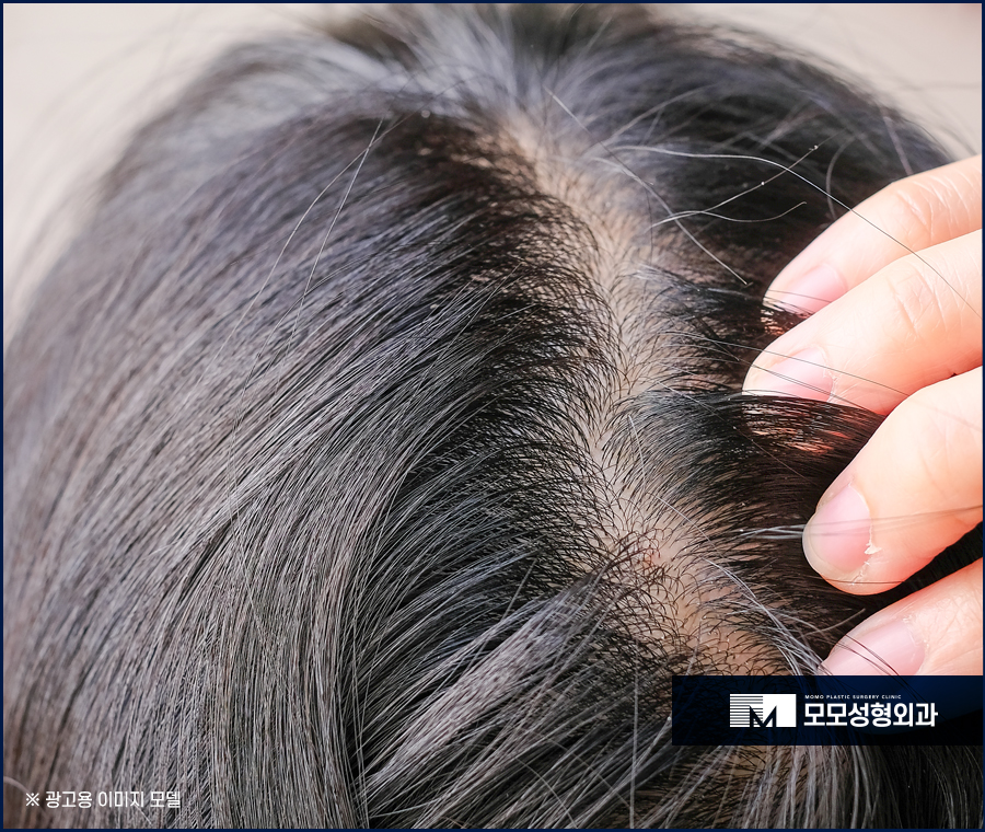 머리이식비용 밀도를 높인 결과로 관련 이미지 3