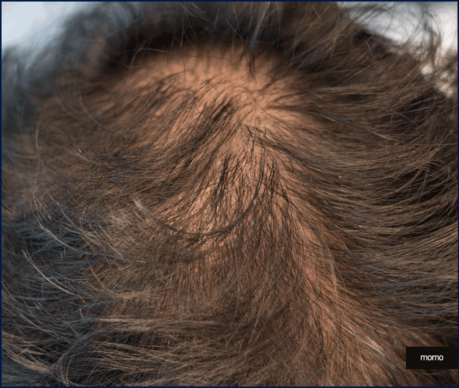 여자 모발이식 헤어라인 교정이 필요하다면 관련 이미지 8