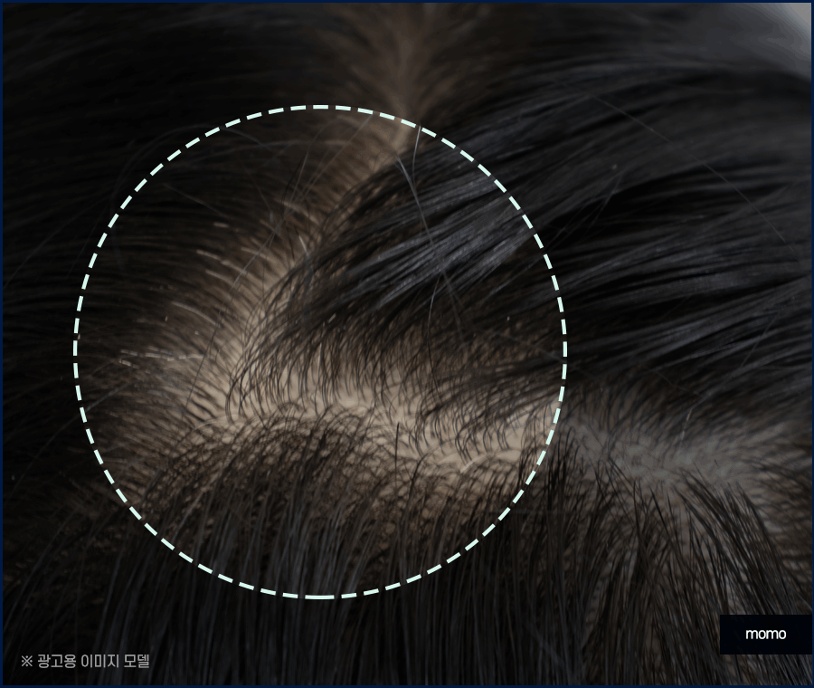 출산후 탈모 자연스럽게 보완하는 방법은 관련 이미지 6