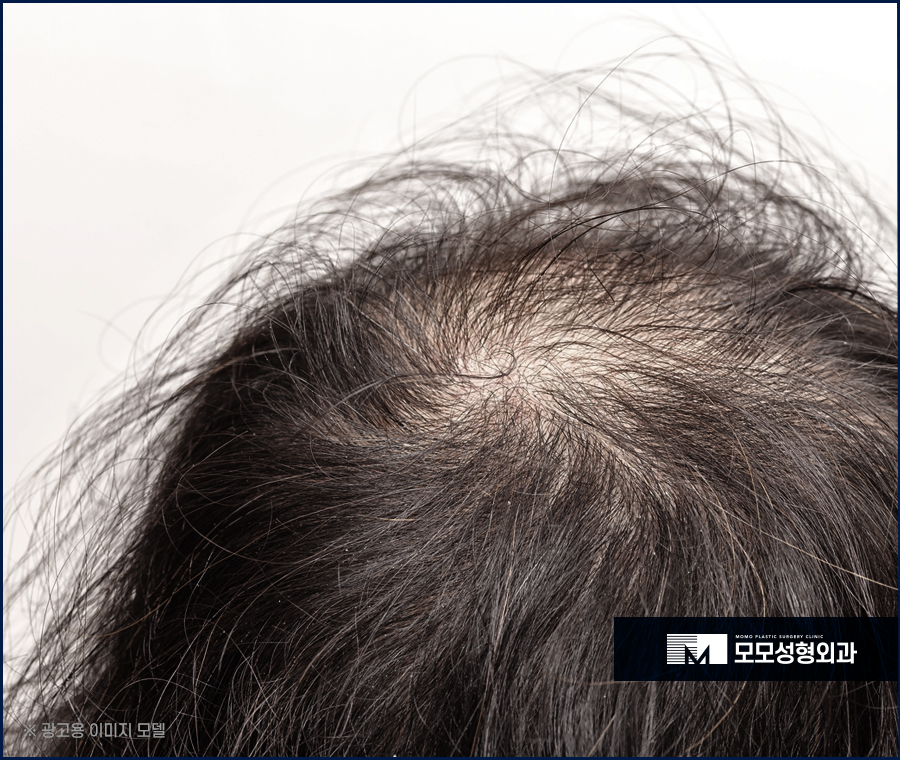 원형탈모 초기 타이밍을 놓치지 말고 대응해야 하는 이유 관련 이미지 5
