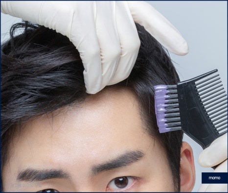모발이식 후 염색 언제쯤 하는게 좋을까요 관련 이미지 2
