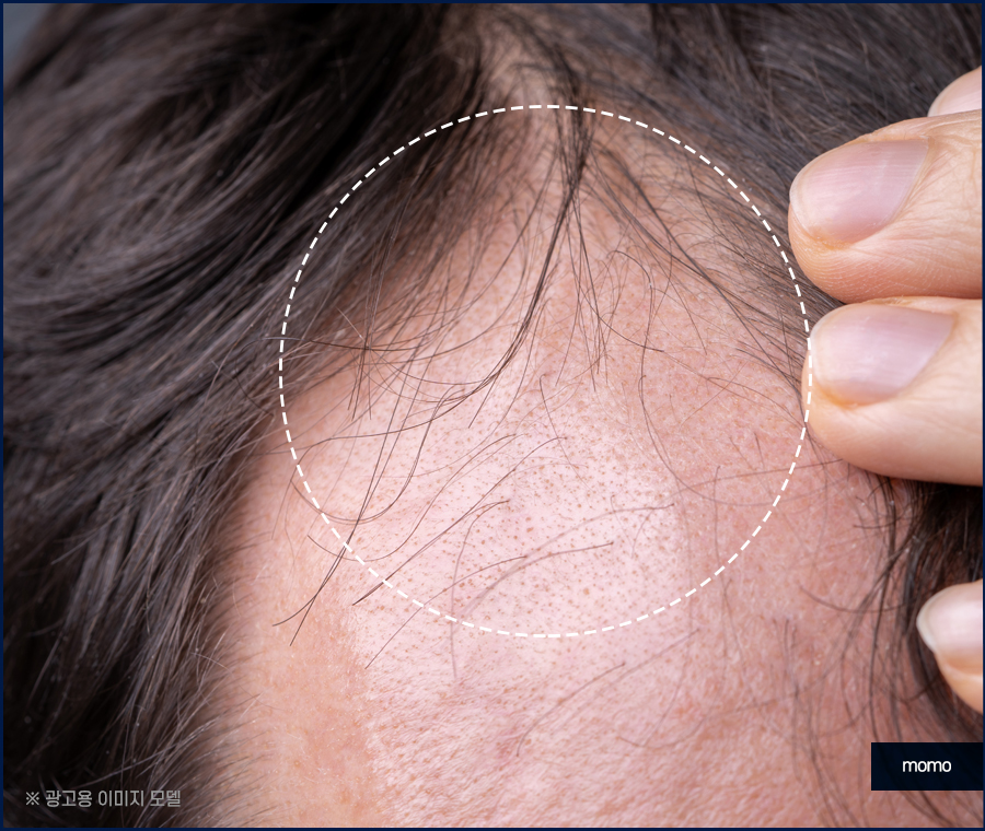 이마 머리 심기 넓은 모습을 보완하기 위한 관련 이미지 3