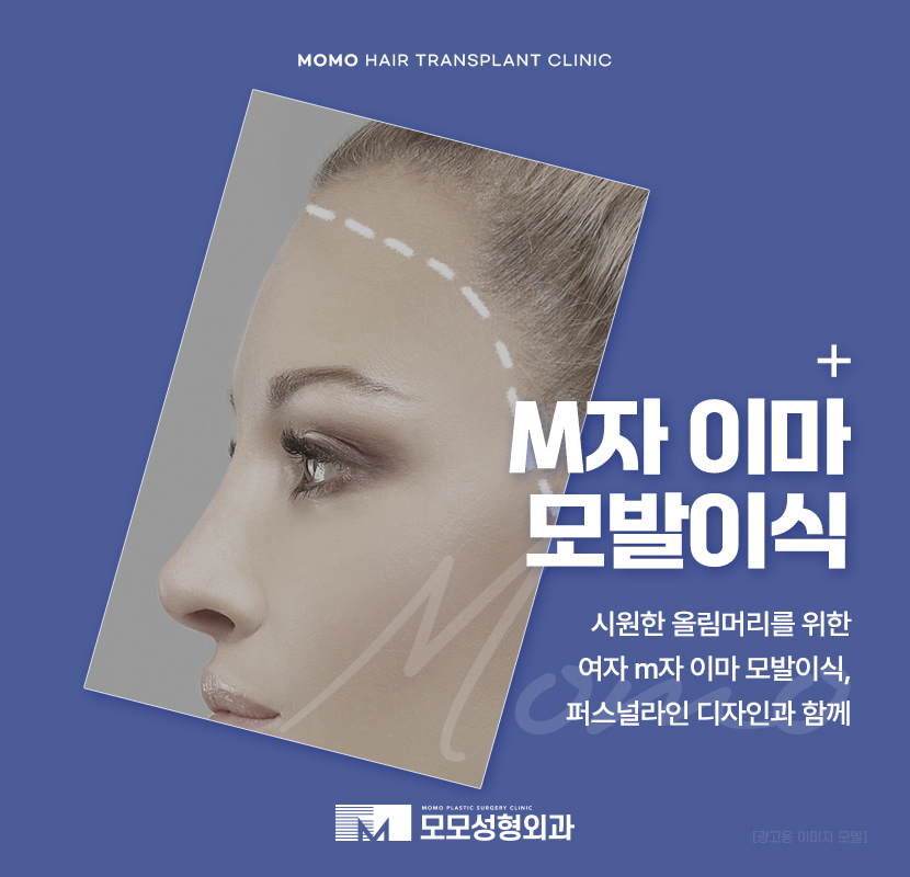 여자 m자 이마 헤어라인 모발이식으로 교정 관련 이미지 1