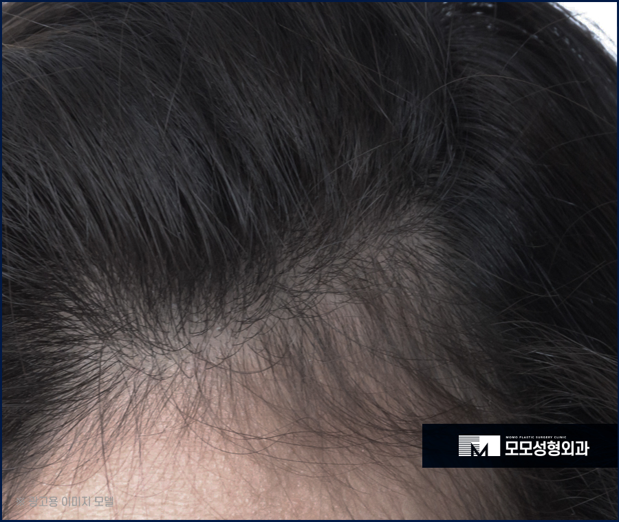 압구정 모발이식 안정적인 생착을 만드는 관련 이미지 2