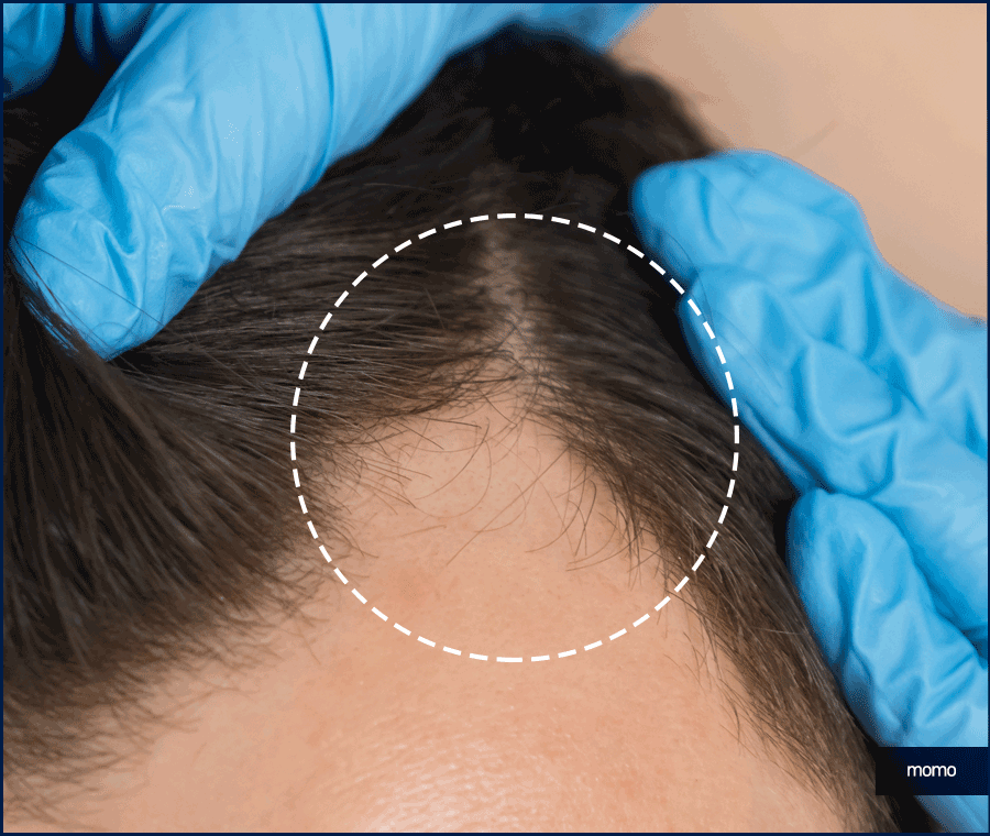 모발이식 2000모 자연스러운 커버 결과 정도는? 관련 이미지 14