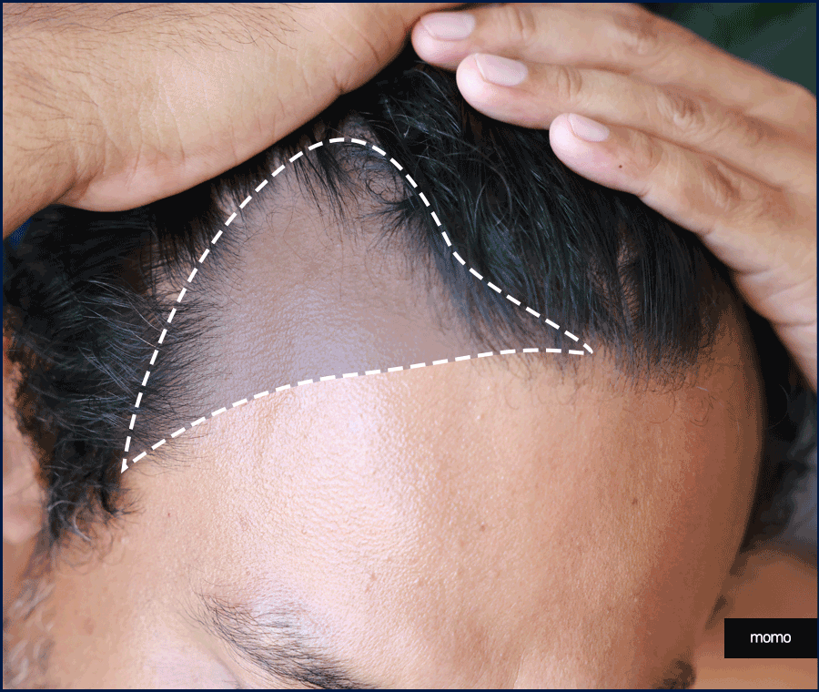 이마 축소술 비용 및 모발이식이 선호되는 이유 관련 이미지 7