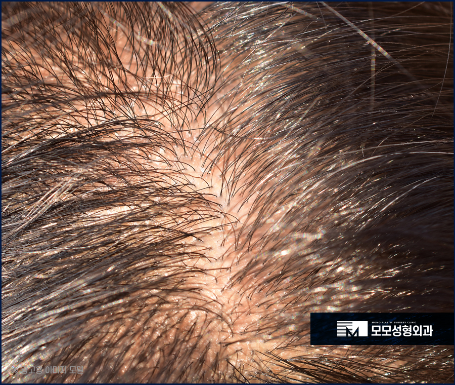 두피 피지알갱이 원인과 없애는 방법은 관련 이미지 3