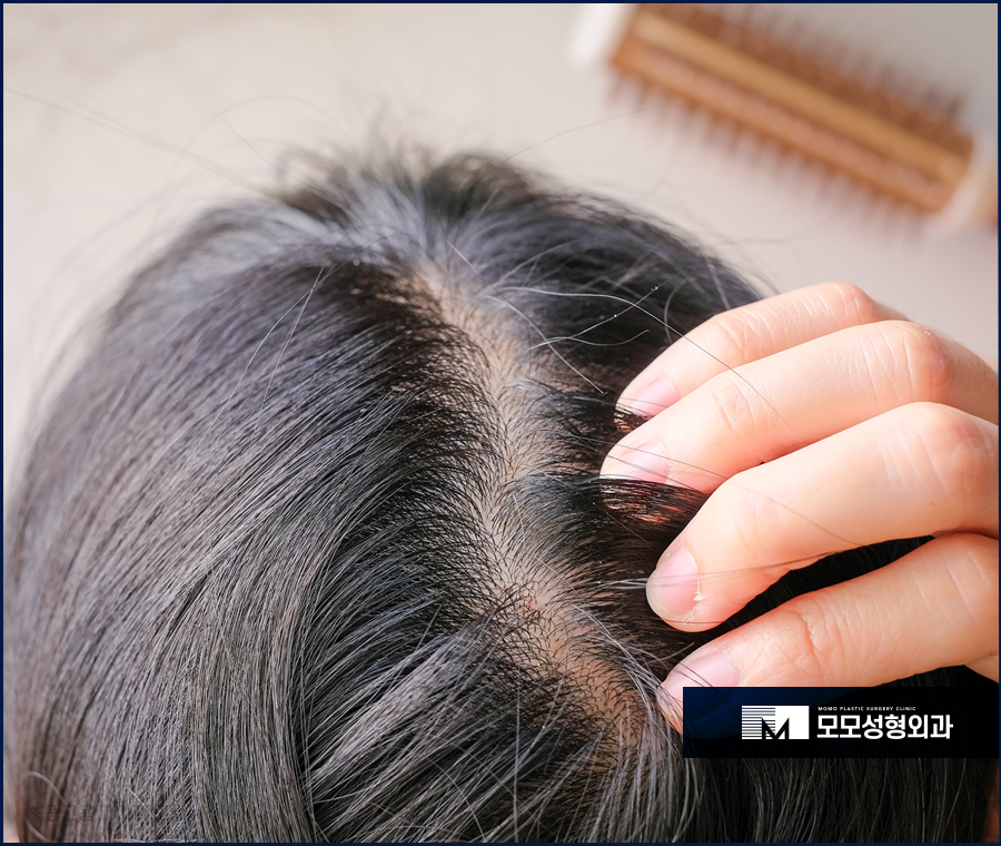 탈모전조증상 미리 알 수 있는 부분은 관련 이미지 4