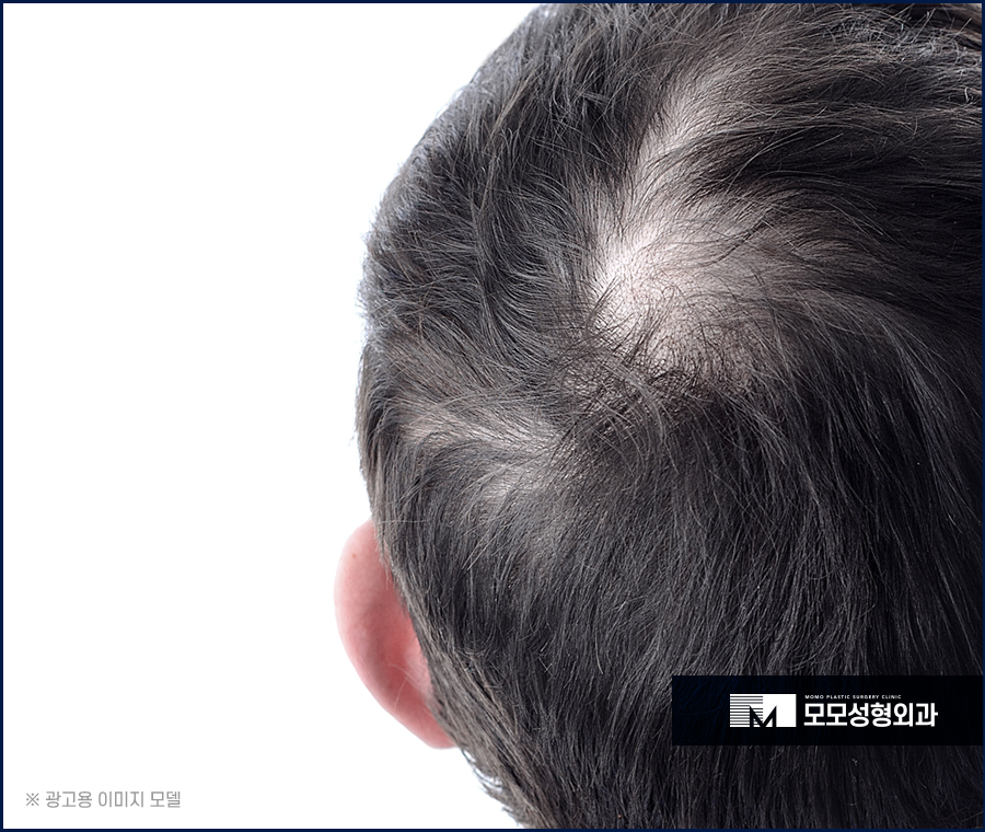 헤어라인모발이식부작용 조심하고 주의해야 할 점은 관련 이미지 2