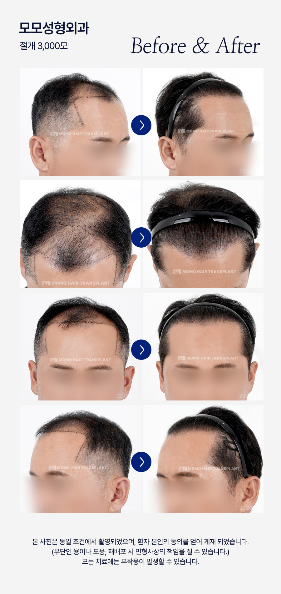 모발이식 생착기간 섬세한 관리가 필요한 이유 관련 이미지 12