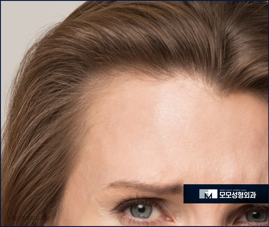 여성앞머리탈모 외모를 위해 보강해야 하는 관련 이미지 3