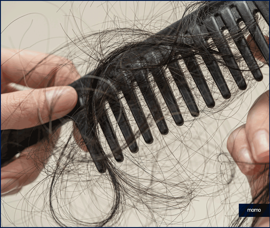 여자 측두부 탈모 아름다운 옆모습을 만드는 방법 관련 이미지 12