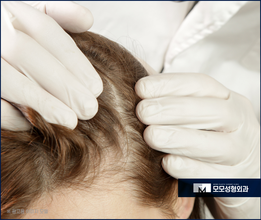 여성헤어라인모발이식 보강이 필요하다면 관련 이미지 6