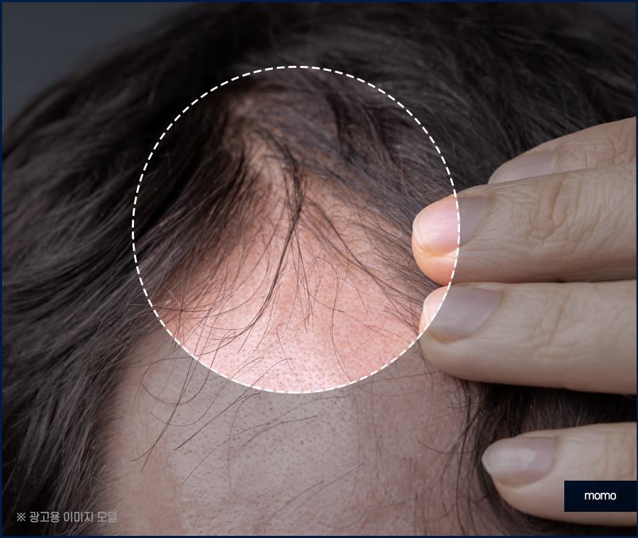 m자탈모초기 현상과 빠르게 대처하면 좋은 포인트는 관련 이미지 3