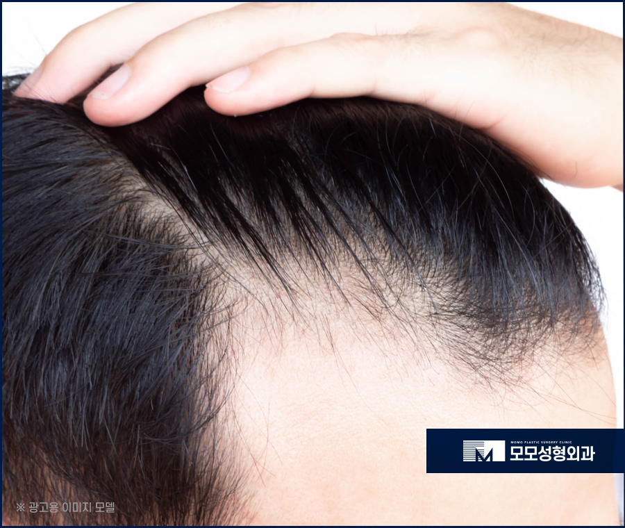 여자M자이마탈모 개인맞춤 진행의 중요성에 대하여 관련 이미지 6