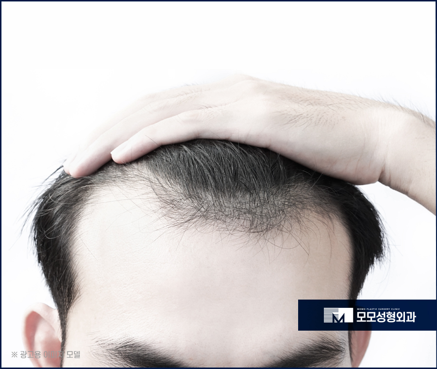 m자탈모모발이식 이미지 개선을 위한 선택 관련 이미지 2