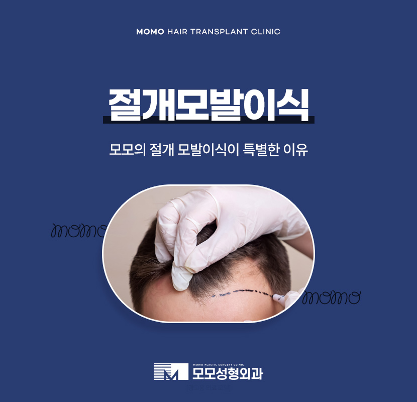 절개모발이식 차이점을 알고 정해야만 관련 이미지 1