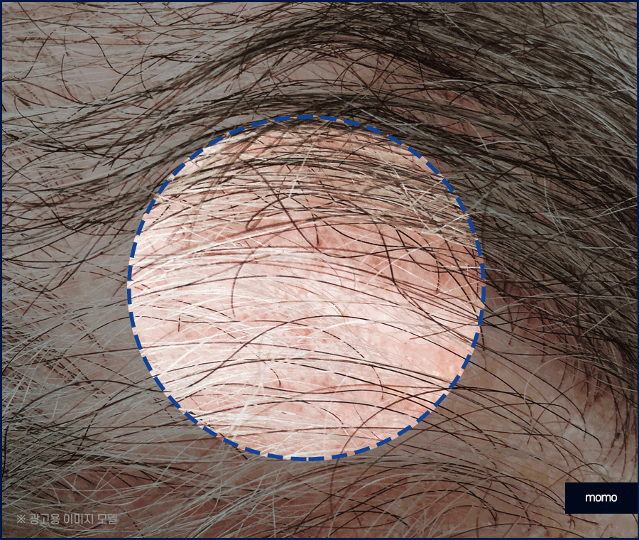 두피피딱지 원인 및 올바른 케어 방법은? 관련 이미지 3