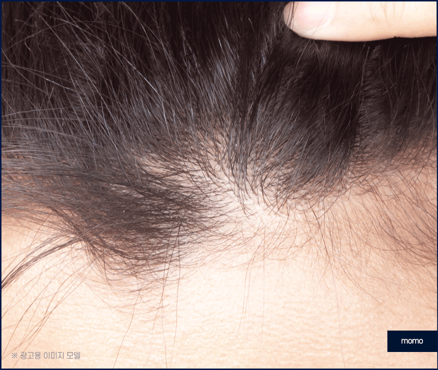 모발이식 생착률 높이기 위한 솔루션은 관련 이미지 5