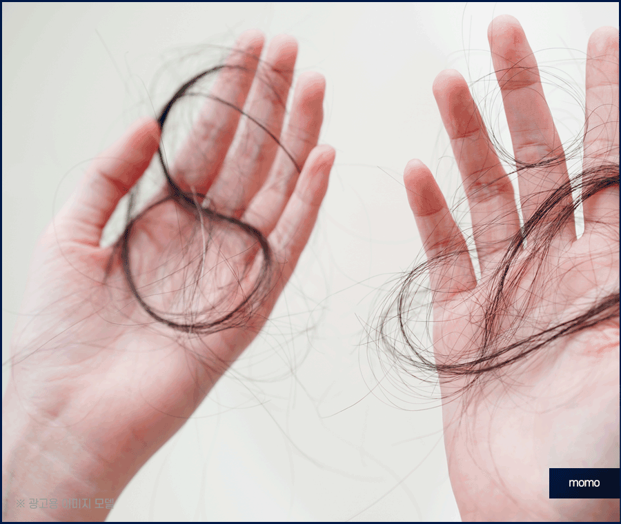 비절개 모발이식 후기와 함께 꼭 알아볼 이것! 관련 이미지 5