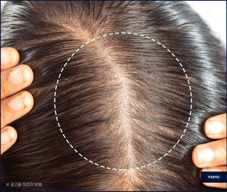출산후 탈모 자연스럽게 보완하는 방법은 관련 이미지 7